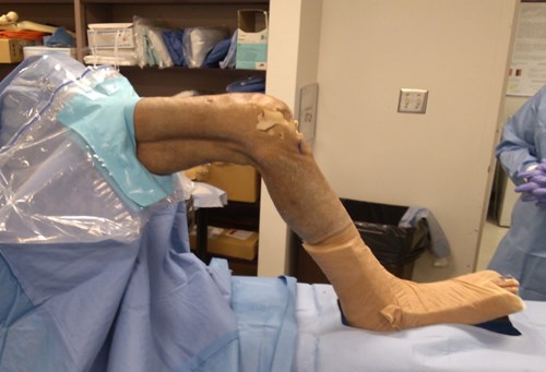 An exposed leg  with cast