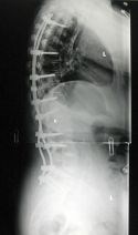 Spine XRAY