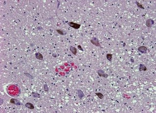 This is a section of the area of the brain called the substantia nigra. The name is derived from the neuromelanin (brown) pigment found in the cytoplasm of the neurons which increases with age.